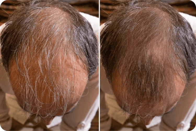 Queda de cabelo